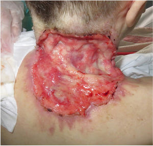 Carcinoma basocelular cervical avanzado.