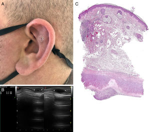 (A) Well-defined non-inflammatory nodules located in the upper helix (small) and scaphoid fossa (biopsy). (B) Ultrasound examination: hypoechoic cystic lesions with anechoic content and posterior reinforcement with increased cartilage thickness in the ultrasounds. (C) Hematoxilin–eosin 10×: intracartilaginous space lacking an epithelial lining with thinning cartilage and hyalinising degeneration along the internal border of the cystic space.