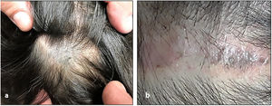 a: Lesión azulada, mal definida, en el cuero cabelludo, compatible clínicamente con nevus azul. b: Área de la cicatriz con pequeños puntos azulados en relación con la lesión residual.
