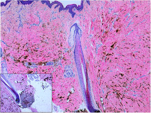 Histología: en la dermis hay células fusiformes melanocíticas dendríticas intensamente pigmentadas, dispuestas difusamente entre el colágeno denso dérmico (H&E × 40). En detalle se observa como las células pigmentadas se concentran alrededor de los bulbos pilosos.