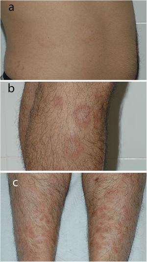 Aspecto clínico de las lesiones anulares a nivel del flanco abdominal derecho a) y la región proximal de las piernas b). Aspecto clínico de las lesiones ictiosiformes a nivel pretibial con grandes escamas poligonales c).