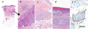 Histopatología de las lesiones de la rodilla derecha a pequeño aumento con presencia de un infiltrado inflamatorio linfohistiocitario con estructuras granulomatosas mal conformadas (hematoxilina/eosina X20) a). A mayor aumento se observa mejor la infiltración granulomatosa de las glándulas ecrinas (hematoxilina/eosina X100), b). Histopatología de las lesiones del muslo con infiltración de glándulas ecrinas por granulomas sarcoideos (hematoxilina/eosina X100), c). Histopatología de las lesiones ictiosiformes pretibiales mostrando hiperqueratosis ortoqueratósica y granulomas sarcoideos dérmicos (hematoxilina/eosina X100), d). e) Tinción inmunohistoquímica para CD136 que muestra una elevada densidad de células CD163 positivas en el área intersticial que rodea los granulomas epitelioides (CD136X100).