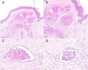 A)Hematoxilina-eosina (×5). B)Hematoxilina-eosina (×10). C y D)Hematoxilina-eosina (×40).