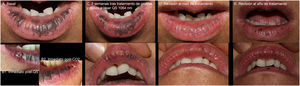 Fotografías clínicas de la paciente. A) Situación basal. B1) Reacción inmediatamente posterior al tratamiento de prueba puntual con láser Nd:YAG Q-switched. B2) Reacción inmediatamente posterior al tratamiento de prueba puntual con láser CO2. C) Situación 3 semanas después de tratamiento de prueba. Se puede apreciar cómo las 2 zonas tratadas muestran aspecto similar en cuanto a desaparición de la pigmentación. D) Respuesta al tratamiento completo con láser Nd:YAG Q-switched 1 mes después de la sesión. E) Imagen un año después de sesión completa registrada en imagen C, con recidiva parcial en el labio inferior, que fue posteriormente tratada con éxito siguiendo el mismo esquema terapéutico.