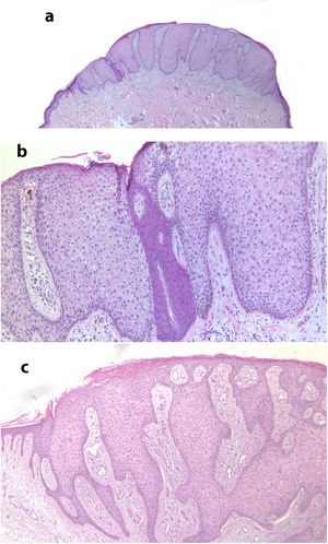 a) Imagen histológica a pequeño aumento de un ACC mostrando un área bien delimitada de hiperplasia epidérmica psoriasiforme, con acantosis a expensas de queratinocitos de citoplasma claro (hematoxilina-eosina x 20). b) Detalle de la lesión anterior donde se observa una delimitación abrupta entre las células claras y las del acrosiringio (hematoxilina-eosina x 100). c) Imagen de otro ACC con papilomatosis y gran acantosis a expensas de queratinocitos de citoplasma claro, así como paraqueratosis y exocitosis de neutrófilos en la superficie (hematoxilina-eosina x 40).