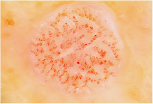 Imagen dermatoscópica que muestra vasos glomerulares dispuestos en collar de perlas (cortesía de la Dra. Yolanda Fortuño, Hospital de Viladecans, Barcelona).