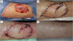 Type 2 Pacman flap for repairing a leg surgical wound after basal cell carcinoma removal. (A) Being the surgical breach localized on the pretibial region, this Pacman was drawn with an asymmetric mouth: the upper jaw of the flap, next to the tibia, was drawn smaller than the lower jaw. This to recruit more tissue where it was more easily mobilized. (B) The flap was undermined above the superficial fascia, moved, and sutured; a dog