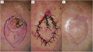 Type 1 Pacman flap for repairing a scalp squamous cell carcinoma removal. (A) Tumor excision with 6mm margins and flap design with a symmetric mouth. (B) Flap undermined in the subcutaneous tissue, except for the jaws and the tail of the flap (undermined up the periosteum), and sutured in place. (C) Good esthetic result at 3 months.