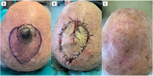 Type 1 Pacman flap for repairing a scalp keratoacanthoma removal. (A) Tumor excision with 5mm margins and flap design with a symmetric mouth. (B) Flap sutured after undermining up to the subcutis or into the subcutis. This reduced flap mobility, as demonstrated by the gap of the closing mouth, but it guaranteed sufficient flap perfusion. (C) Post-operative result at 1 year showed an optimal reconstruction.