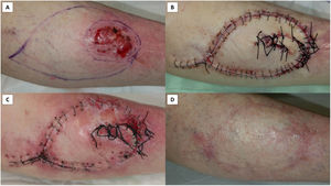 Type 3 Pacman flap for repairing a leg basal cell carcinoma removal. (A) Pacman flap drawn with asymmetrical mouth and tumor extirpation with 4mm margins. (B) The flap and surrounding skin motion were not sufficient to cover entirely the defect width, while they were more than enough to cover its length. Thus, the lower jaw of the flap mouth was rotated on itself in a logarithmic fashion. This permitted to repair completely the surgical wound. (C) The flap suffered epidermal necrosis of the tip, but it did not require further procedures or specific dressings. (D) At 4 months the result achieved was good with great patient satisfaction.