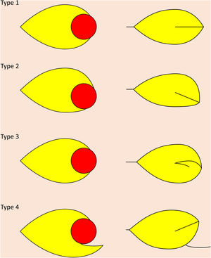 Colgajo Pacman y sus modificaciones. Tipo 1 = estándar; tipo 2 = asimétrico; tipo 3 = logarítmico; tipo 4 = transposición/colgajo pediculado en isla en pinza de cangrejo.