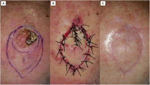 Colgajo Pacman tipo 1 para la reconstrucción de un carcinoma epidermoide de cuero cabelludo. A) Extirpación del tumor con márgenes de 6 mm y diseño del colgajo con una boca simétrica. B) Disección del colgajo en el plano del tejido subcutáneo, excepto por las mandíbulas y la cola del colgajo (disección llegando hasta el periostio), y sutura. C) Buen resultado estético a los tres meses.