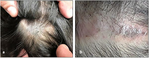 A, Poorly defined bluish lesion on the scalp that was clinically compatible with blue nevus. B, Area of scarring with small bluish dots associated with the residual lesion.