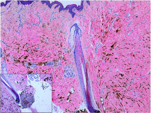 Histology. The dermis contains intensely pigmented dendritic melanocytic spindle cells arranged diffusely between the dense dermal collagen (hematoxylin–eosin, ×40). The inset shows how the pigmented cells are concentrated around the follicular bulbs.