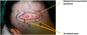 Schematic representation of the Mohs technique. Reference marks on the skin and specimen to be removed. In section 1, the microscope reveals residual foci of neurocristic hamartoma that are completely removed. In section 2 (A–F), there is no residual lesion.