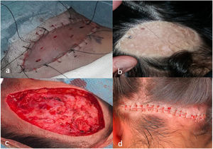 A, Placement of a skin graft. B, Appearance of the graft at 5 months. C, Removal of the graft. D, Closure of the wound without tension.