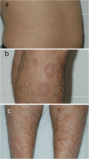 Clinical appearance of annular lesions on the right abdominal flank (A) and proximal aspect of the legs (B). Clinical appearance of ichthyosiform lesions in the pretibial area, with large polygonal scales (C).