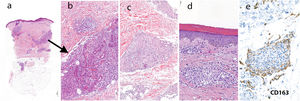 Histopathology of lesions on the right knee at low magnification with the presence of a lymphohistiocytic inflammatory infiltrate and poorly formed granulomatous structures (hematoxylin–eosin, ×20). A, Increased magnification better reveals the granulomatous infiltration of the eccrine glands (hematoxylin–eosin, ×100). B, Histopathology of the lesions on the thigh, with infiltration of the eccrine glands by sarcoid granulomas (hematoxylin–eosin, ×100). C, Histopathology of pretibial ichthyosiform lesions showing orthokeratotic hyperkeratosis and sarcoid granulomas in the dermis (hematoxylin–eosin, ×100) (D). E, Immunohistochemistry for CD163 showing a high density of CD163-positive cells in the interstitial area surrounding the epithelioid granulomas (CD163, ×100).