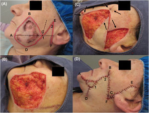 Photographs during surgery. (A) Flap incision lines (in red) and imaginary ones (in black). (B) Defect after tumor excision. (C) The flap could only close the posterior part of the defect (cheek). (D) Immediate postoperative period, in which a Burow advancement flap was placed on the anterior area (mandibular).