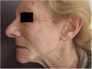 Outcome 5 years after surgery. Note the satisfactory cosmetic outcome achieved.