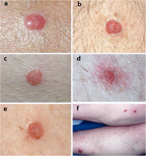 Clinical appearance of clear cell acanthosis. A, Typical lesion with an erythematous dotted scaly collarette. B–D, Erythematous dome-shaped lesions with a scaly collarette. E, Dome-shaped lesion with a scaly surface. F, Multiple lesions on the lower limbs.