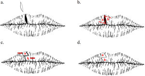 The technique involves elliptical excision of the fissure following the tension lines of the lip (A) and subsequent design of two triangular flaps, which are traced with a scalpel (B). Once traced and after appropriate release of the tissue, the triangular flaps are transposed contralaterally, and the defect is sutured (C and D).
