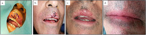 Design of Z-plasty in a patient with chronic lip fissure (A). Appearance of the wound immediately after surgery (B), on removal of the stitches, at 1 week (C), and at 2 weeks (D).