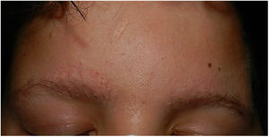 Eritema y pápulas foliculares en frente y cejas con alopecia parcial.