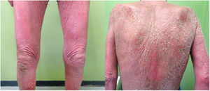 Eritrodermia maculopapular descamativa. Se objetiva una intensa descamación y eritrodermia franca.