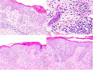 Biopsias cutáneas. Imágenes superiores (1° Biopsia): Epidermis con marcada espongiosis, exocitosis de celularidad inflamatoria formando vesículas intraepidérmicas y focos de paraqueratosis con un infiltrado inflamatorio perivascular e intersticial constituido por linfocitos y numerosos eosinófilos. Imágenes inferiores (2° Biopsia): Epidermis con moderada acantosis y paraqueratosis focal. En dermis papilar se observa un infiltrado linfoide con marcado epidermotropismo y formación de un microabsceso de Pautrier.