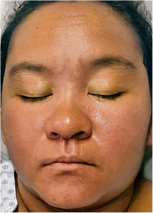 Edema y eritema facial.