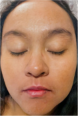 Resolución del edema y eritema facial 5 días después del tratamiento con valganciclovir.
