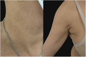 (a, b) Thin grouped papules with a “cobblestone” appearance over the lateral neck and axilla, resembling pseudoxanthoma-elasticum.