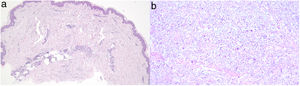(a) Interstitial dermal infiltrate of histiocytes in superficial and deep reticular dermis and perivascular lymphocytic infiltrate (hematoxylin and eosin 40×). (b) Deposition of mucin yielded by Alcian blue stain (hematoxylin and eosin 60×).
