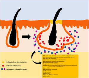 Inflammatory pathways in hidradenitis suppurativa.