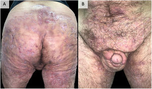 Example of extremely serious hidradenitis suppurativa. A 48-year-old man with HS of >20 years’ duration, refractory to multiple treatments, including high-dose adalimumab, infliximab, and ustekinumab. Currently, in treatment with bimekizumab. Photographs taken and published with the oral and written consent of the patient.