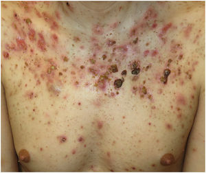 Comedones, pápulo-pústulas, nódulo-quistes, erosiones, ulceraciones y costras, en un paciente con acné fulminans.