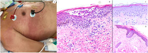 Maculo-papular reaction in a patient in intensive care unit showing confluent erythematous and purplish papules mostly involving flanks and bank and with scarce vesicles. Histopathology shows an intraepidermal collection of neutrophils and Langerhans cells. A slight vacuolar interphase as well as a light perivascular lymphocytic infiltrate are shown. Right panel shows neutrophilic epitheliotropism (upper picture) and eccrine syringometaplasia in clinically similar cases, where few neutrophils can be observed in the upper epidermis without conforming a pustule.