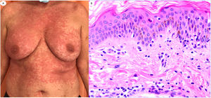 Urticariform reaction in a 62-year-old female showing scarce perivascular inflammatory infiltrate with polymorphonuclear (PMN) cells and few eosinophils, vacuolar degeneration, epitheliotropic PMN and few apoptotic keratinocytes. Lesions appeared at home, after the patient with COVID-19 pneumoniae was discharged from the hospital.