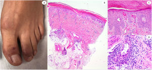 Purplish plaques in the feet of a 42-year-old male. Histopathology shows dense lymphocytic inflammatory infiltrate, surrounding vessels and adnexal structures. Red cell extravasation is observed in the dermal papilla as well as clear-cut endotheliitis.