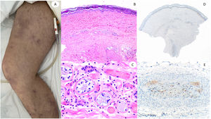 60-Year-old male, in intensive care unit due to bilateral COVID-19 pneumonia, with reticular lesions in both legs. Histopathology shows eccrine gland necrosis as well as the presence of red thrombi within the reticular dermis vessels. Right side shows anti-spike 3 where granular staining can be observed in an area in which a dermo-hypodermal vessel is occluded by a neutrophil-rich thrombi.