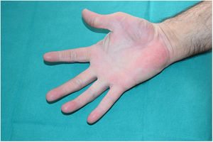 Erythema with fine palmar scaling.