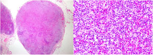 Lymph node biopsy. Erasure of the general architecture of the lymph node, with loss of lymphoid follicles in the cortex, replaced by a diffuse lymphoid proliferation. At higher magnification, generalized lymphoid expansion can be seen, accompanied by numerous eosinophils.
