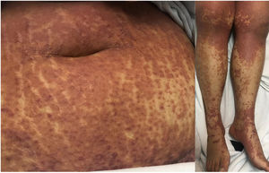 Bilateral disseminated dermatosis, characterized by a morbilliform rash.