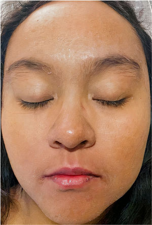 Resolution of the edema and facial erythema 5 days after treatment with valganciclovir.