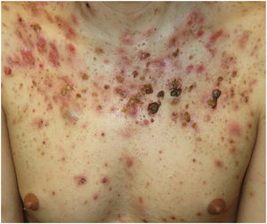 Comedones, papules and pustules, nodules and cysts, erosions, ulcerations, and crusting in a patient with acne fulminans.