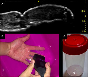 A, Glass splinter (white arrow) in the third finger visualized by clinical ultrasound using the water-bath technique (B). C, Surgically removed glass splinter.