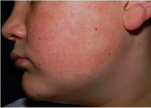 Minute hyperkeratotic papules on an erythematous base on the left cheek.