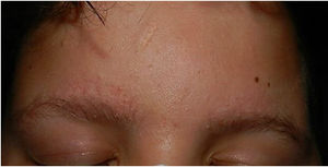 Follicular papules and erythema on the forehead and eyebrows, with partial alopecia.