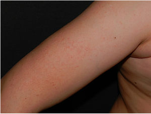 Multiple hyperkeratotic papules on the external surface of the right arm.